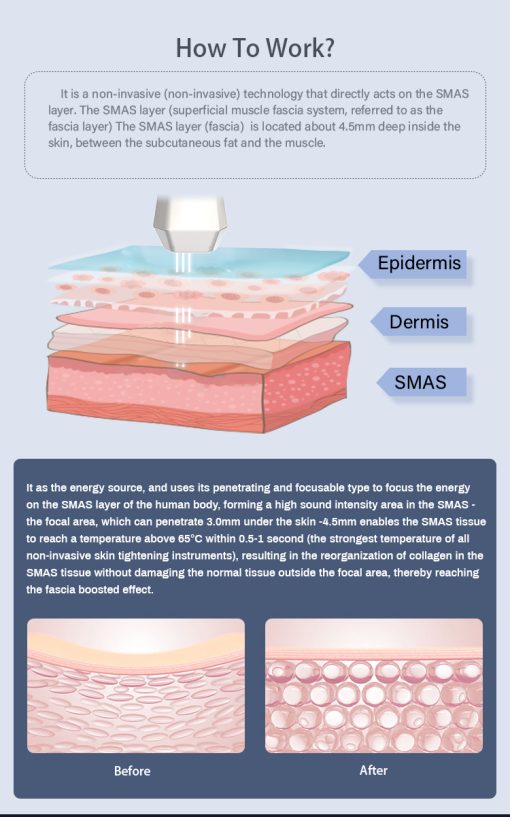 HIFU Treatments - Black Edition - Image 3