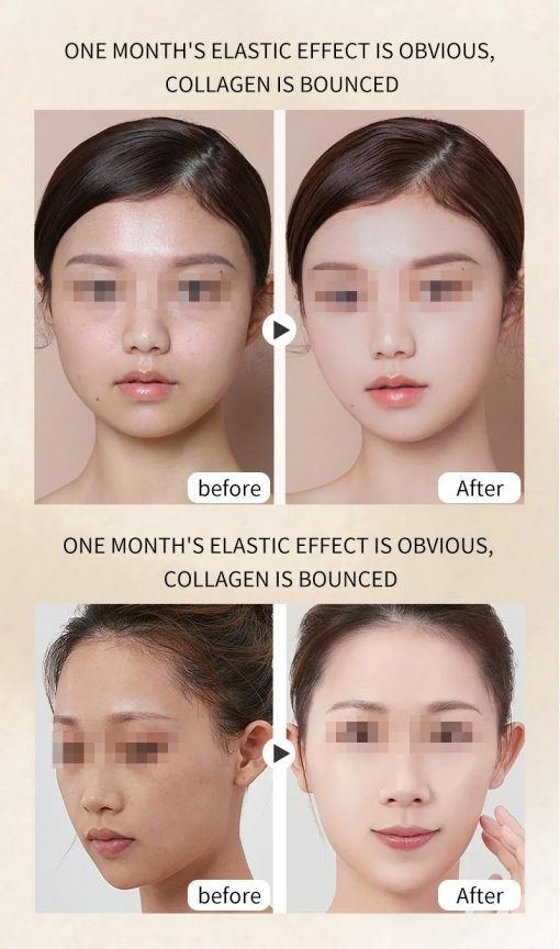 HIFU Face Lifting Device - White Edition - Image 2